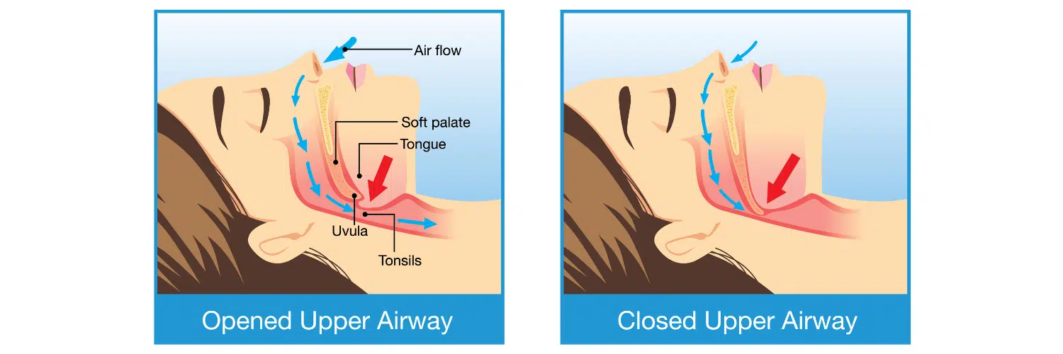 Diagram to explain what causes snoring